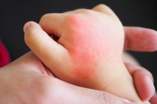 Jak wygląda alergia skórna u dzieci i dorosłych?