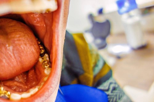 Jak długo trwa grzybica jamy ustnej?